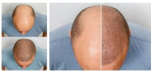 Analyse des cas réels : méthodes utilisées. clinique de greffe de cheveux Turquie