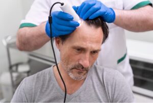Avant et après une greffe de cheveux FUT