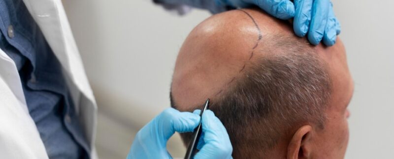 Avant et après une greffe de cheveux FUT : comment la ligne frontale change en 6 mois