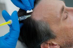 Évaluation de la Perte de Cheveux et Zone Donneur. greffe de cheveux : combien de follicules