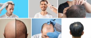 Facteurs influençant la réussite. greffe de cheveux
