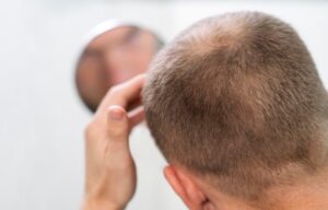 Facteurs influençant le coût de la greffe de cheveux