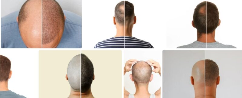 Galerie photos avant et après une greffe de cheveux : analyse de 30 cas réels
