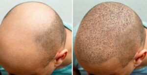 clinique greffe de cheveux Turquie