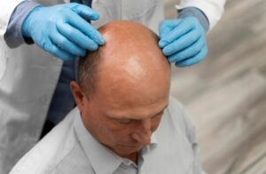 Gérer ses attentes pour un résultat satisfaisant. greffe de cheveux en Turquie