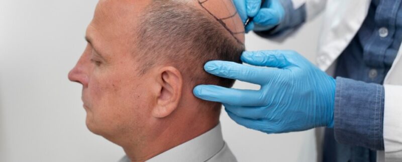 Greffe de cheveux DHI jour après jour : évolution visuelle complète