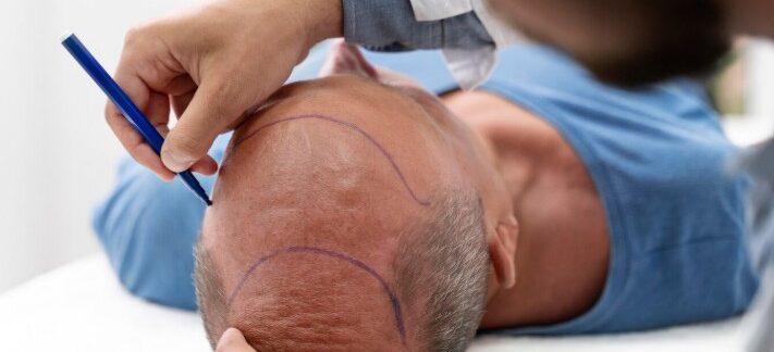 Greffe de cheveux Sapphire FUE : pourquoi la lame en saphir accélère la cicatrisation