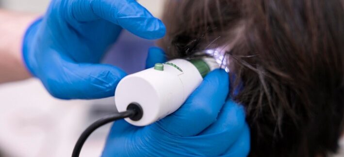 Greffe de cheveux : combien de follicules faut-il pour obtenir un résultat naturel