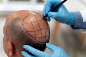 Est-ce que le Minoxidil ou le Finastéride annulent les résultats d'une greffe