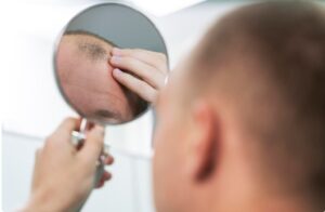 Quel est le Coût Moyen d'une Greffe de Cheveux FUT