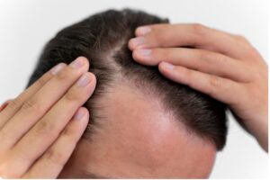 Quelle est la Durée de la Période de Récupération. greffe de cheveux en Turquie