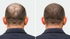Qu’est-ce qu’une greffe de cheveux. après une greffe de cheveux