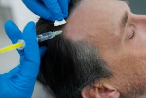 Repousse Précoce et Apparition des Nouveaux Cheveux. resultat greffe de cheveux