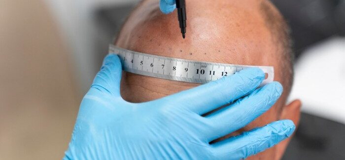 La FUE Micro Safeguard : Innovation et Sécurité dans la Greffe de Cheveux en Turquie technique fue micro safeguard