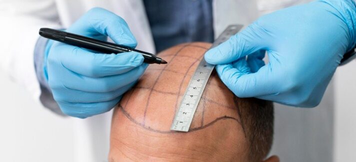 Ultra-Refined FUT : troisième génération de la technique strip expliquée en détail