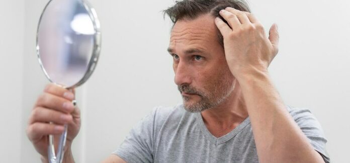 Homme recevant un traitement contre la perte de cheveux- Après une greffe de cheveux
