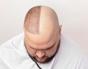 Avant et après la greffe capillaire