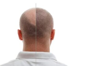 résultats définitifs d'une greffe de cheveux