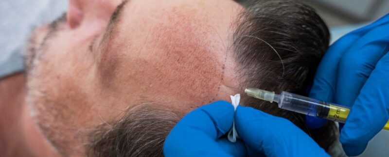 Combien de temps faut-il attendre pour voir les résultats d'une greffe de cheveux