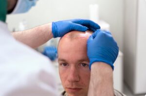 Comment soulager la douleur après une greffe de cheveux