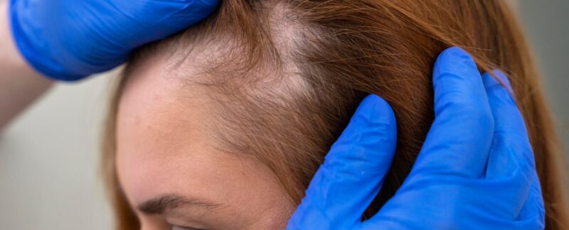 Est-il normal de perdre des cheveux après une greffe de cheveux