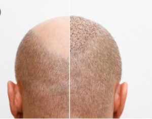 Greffe capillaire avec 3000 greffons : Avant et après- clinique greffe de cheveux Turquie
