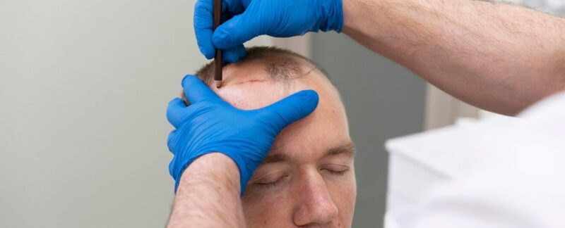 Greffe capillaire avec ligne frontale naturelle