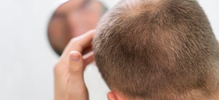 Images HD de densité accrue : cas réels de greffe de cheveux avant/après