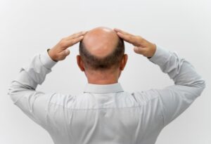 Les raisons d'une deuxième greffe de cheveux