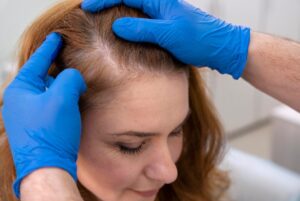 Qu'est-ce que le "Shock Loss" ou choc effluvium- Préparer le cuir chevelu pour une greffe de cheveux