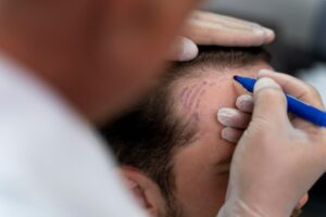 Une bonne hygiène capillaire, la clé du succès d'une greffe de cheveux