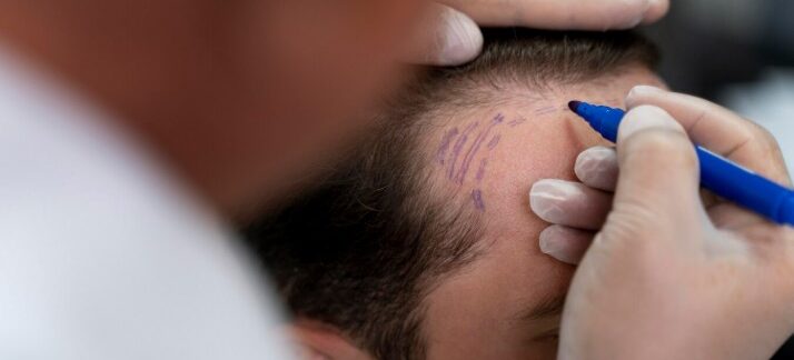 Une bonne hygiène capillaire, la clé du succès d'une greffe de cheveux