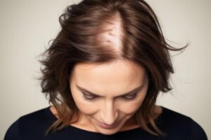 cheveux transplantés après une greffe de cheveux féminine sont-ils permanents