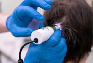 Analyse densitométrique : données numériques avant et après la greffe de cheveux