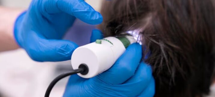 Analyse densitométrique : données numériques avant et après la greffe de cheveux