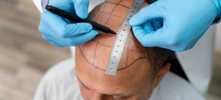 Bande avec sutures trichophatiques dans la greffe de cheveux