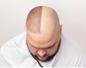 Causes des greffes de cheveux ratées