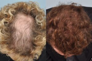Cheveux bouclés et greffe capillaire : images avant et après