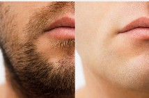 Comment se déroule la récupération après une greffes de cheveux avec des poils de barbe