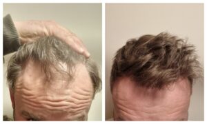 Des exemples de résultats impressionnants- greffe de cheveux Turquie