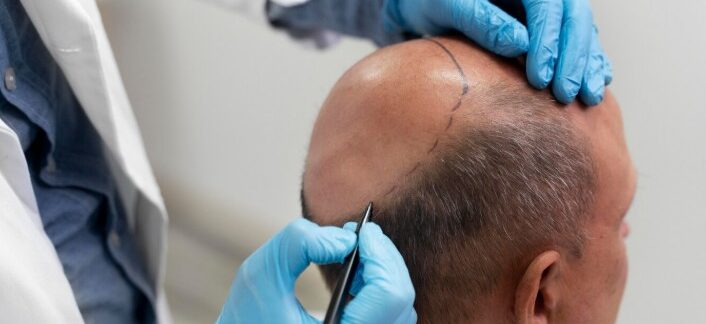 greffe de cheveux micro fue 06 mm