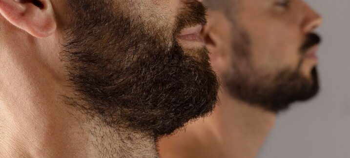 Greffe de cheveux avec des poils de barbe avant et après