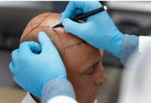 La micropigmentation du cuir chevelu et les perruques médicales- greffe de cheveux