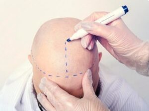 Le Processus de la Greffe de Cheveux Micro FUE 0,6 mm- resultat greffe de cheveux