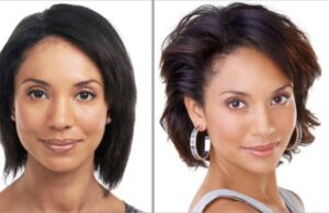 Les résultats de la greffe de cheveux Turquie