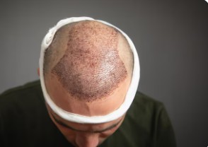 Les techniques de greffe de cheveux et les cicatrices- greffe de cheveux laisse des cicatrices visibles