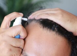 Les traitements topiques (Minoxidil et Finasteride)- greffe de cheveux en Turquie.