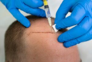 L'importance du choix du professionnel et des soins post-opératoires- resultat greffe de cheveux