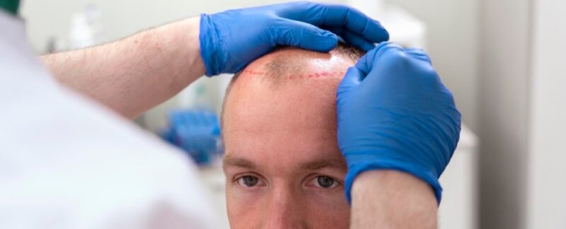 L’influence des médicaments sur la réussite d’une greffe de cheveux
