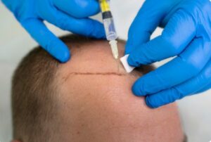 Qu'est-ce que la Suture trichophatiques- sutures trichophatiques dans la greffe de cheveux
